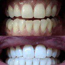 Load image into Gallery viewer, Snow® At-Home Teeth Whitening Kit - 50% Off