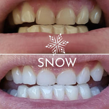 Load image into Gallery viewer, Dual-light, WIRELESS, Self-Sanitizing Snow® Smart Teeth Whitening At-Home System