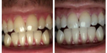 Load image into Gallery viewer, Floyd Mayweather's Snow Teeth Whitening™ At-Home System [All-in-One Kit]
